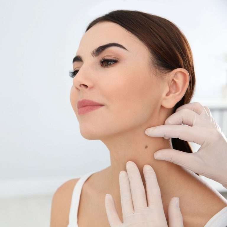 “Understanding Skin Tags and How to Remove Them Safely”