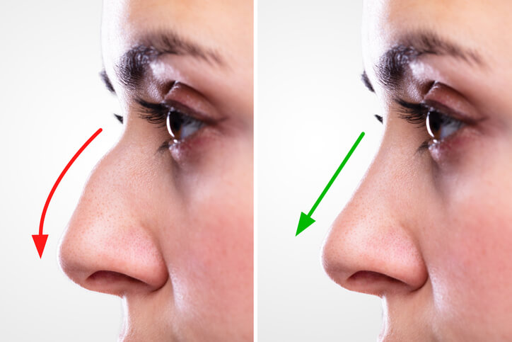 The Islamabad Nose Job Guide: Understanding Rhinoplasty Nose Reshaping Options