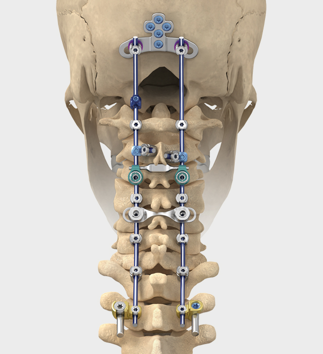 Cervical Spacer Systems Market Trends & Forecast 2033 | FMI